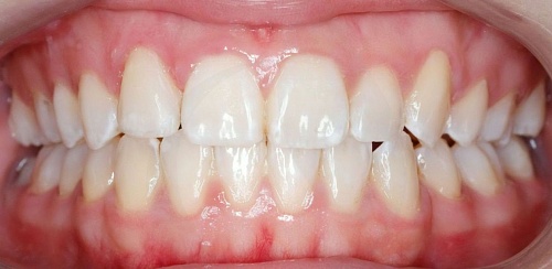 Usynlig tannregulering etter behandling
