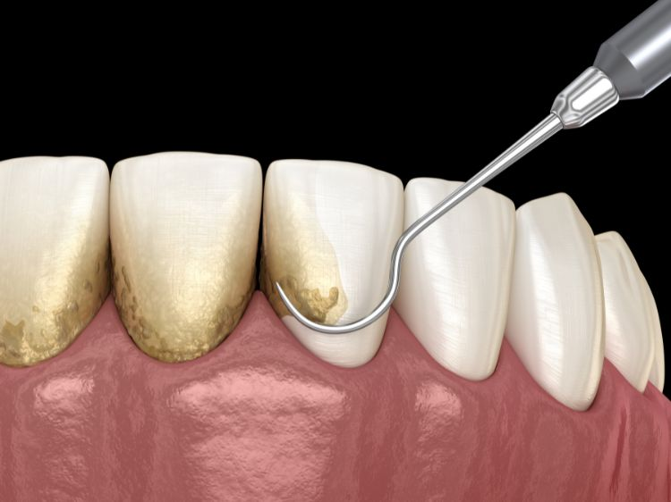 utviklingen av periodontitt
