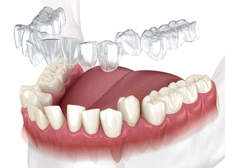 Regulering som retter opp tennene med gjennomsiktige retainer 
