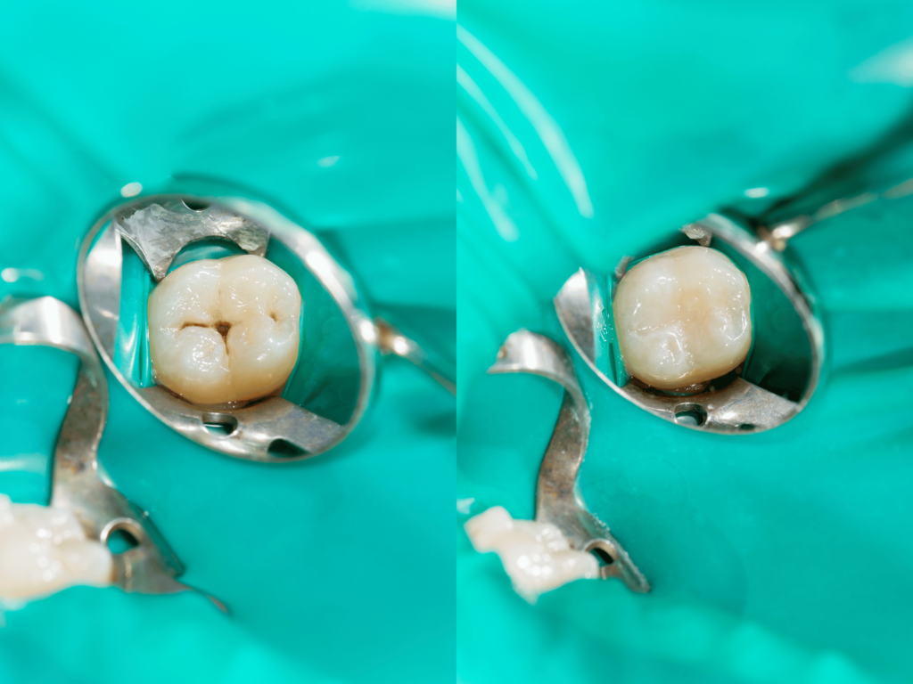 Før og etter tannfylling