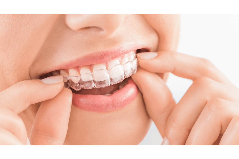 invisalign tannregulering