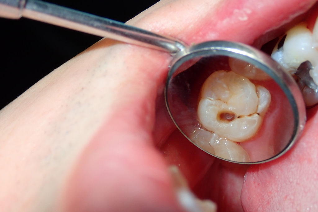 Tannråte / Karies i en tann
