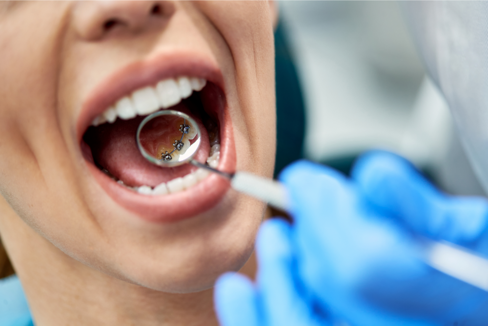Incognito - Tannregulering bak tennene