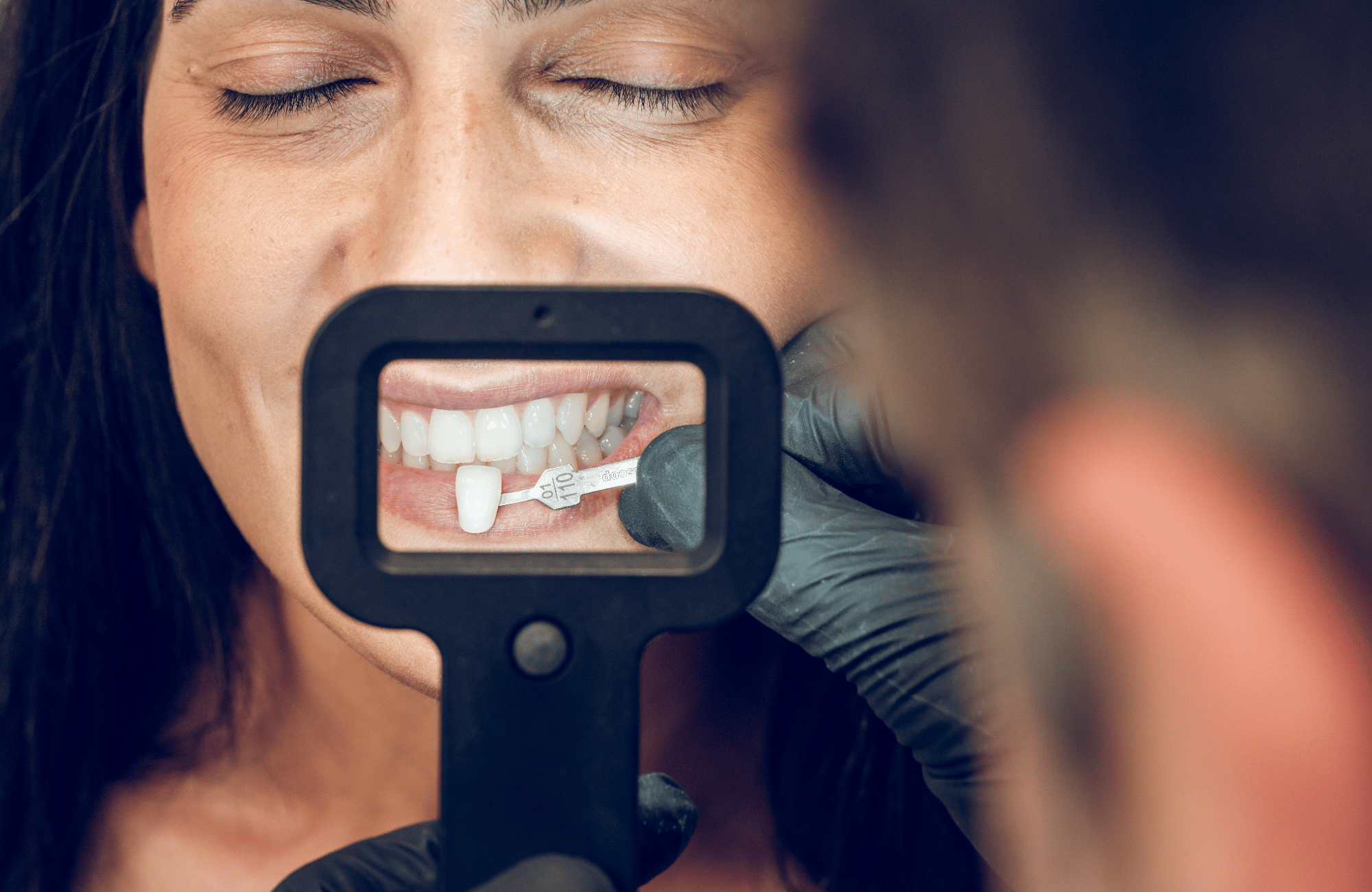 Tannlegen matcher skallfasettene med dine naturlige tenner
