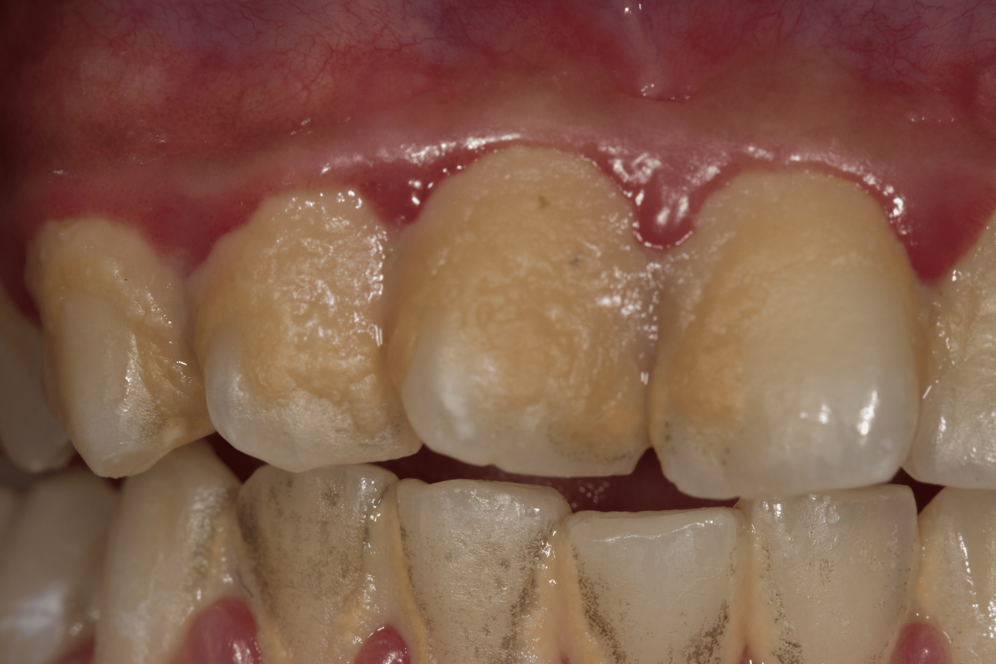 Plakk og tannstein kan føre til utviklingen av periodontitt