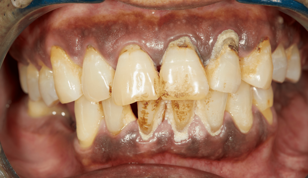 Peridontitt - marginal peridontitt eller alvordlig tannkjøttbetennelse