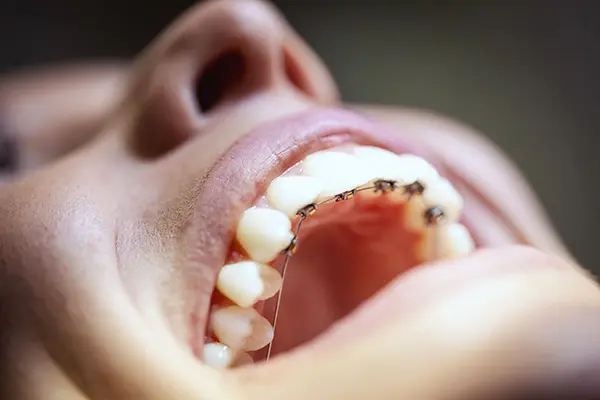 Man kan også på regulering på baksiden av tennene