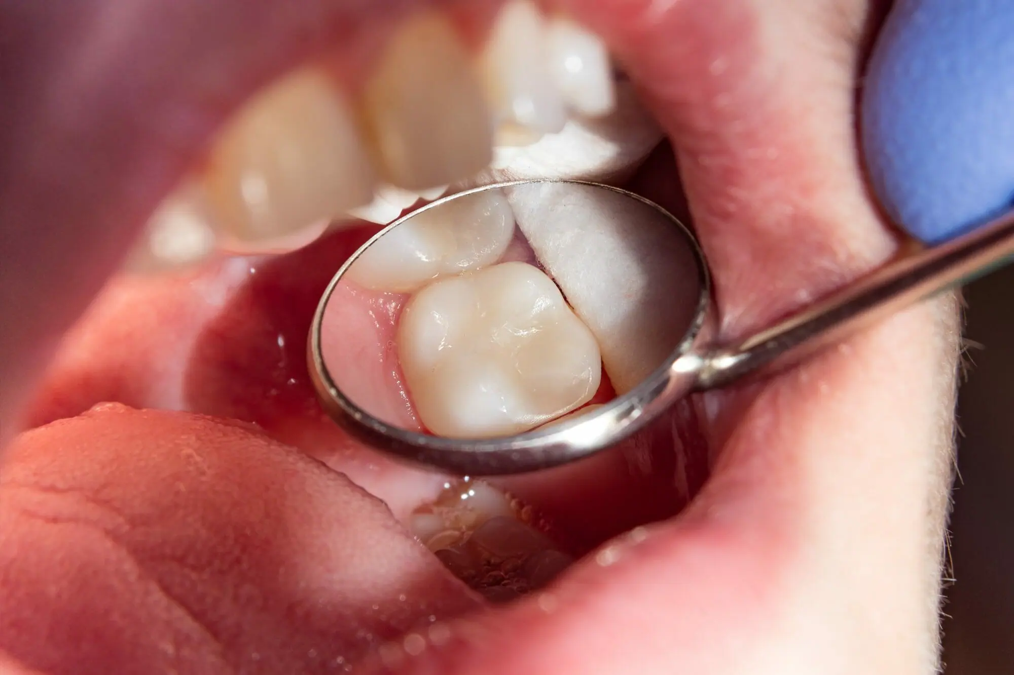 Riktig fylling kan redusere ising i tennene og annet ubehag