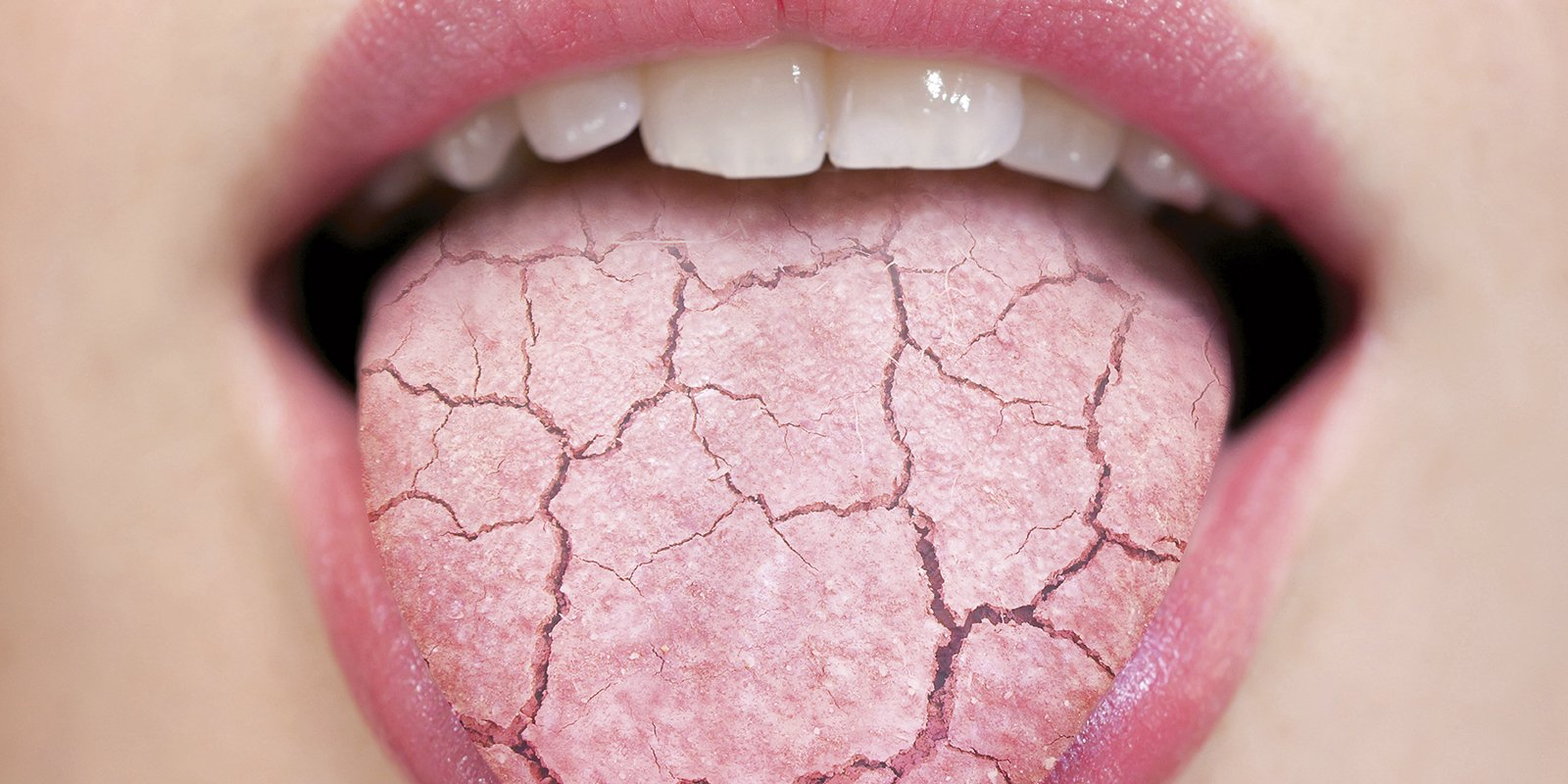 Munntørrhet kan føre til en tørr tunge