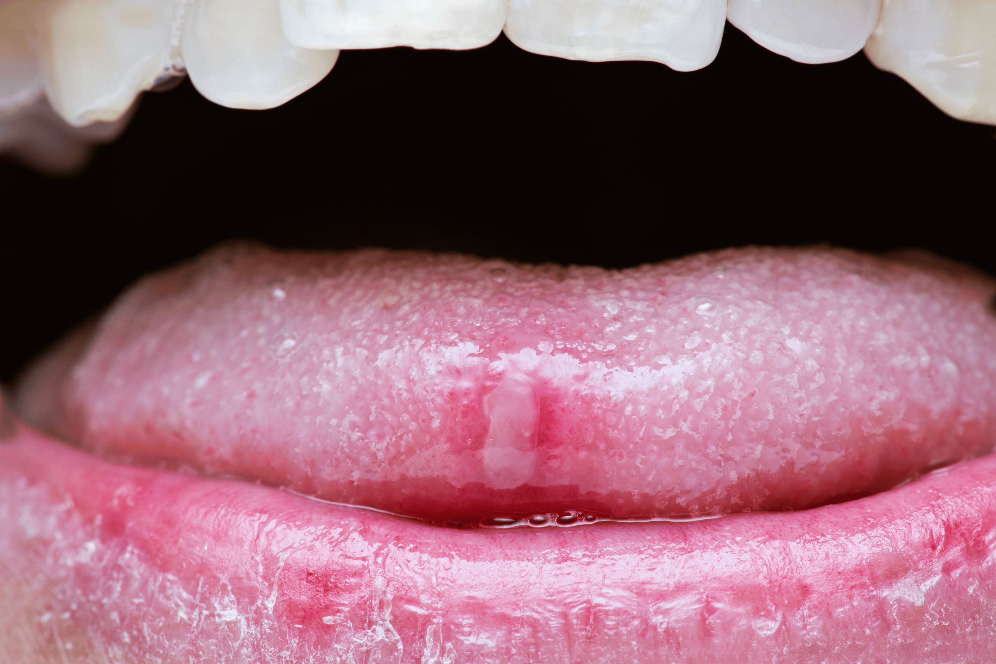 Munnskold på tungen