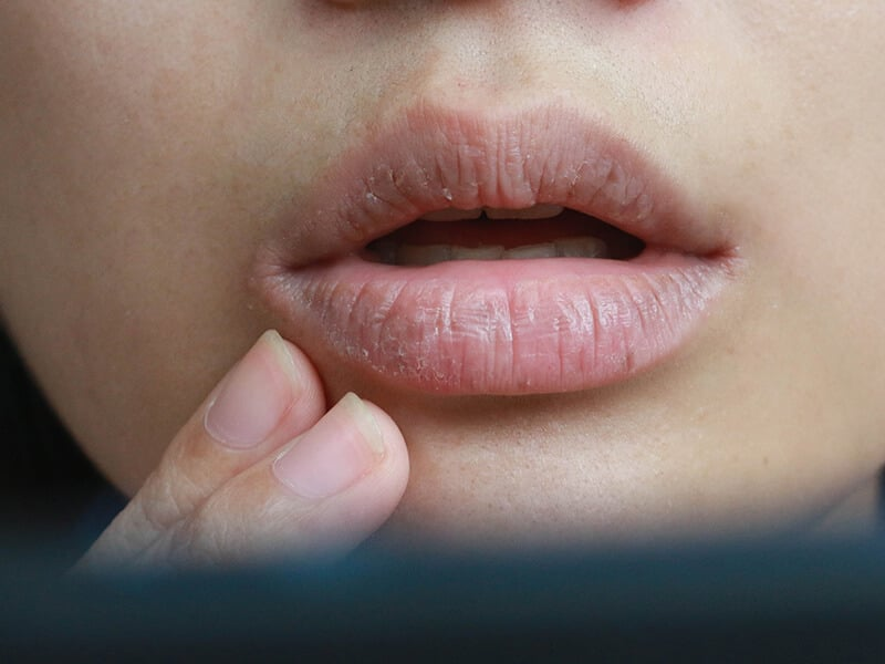 Det er ikke bare munnhulen som kan være tørr, da leppene kan føles ru og flakete