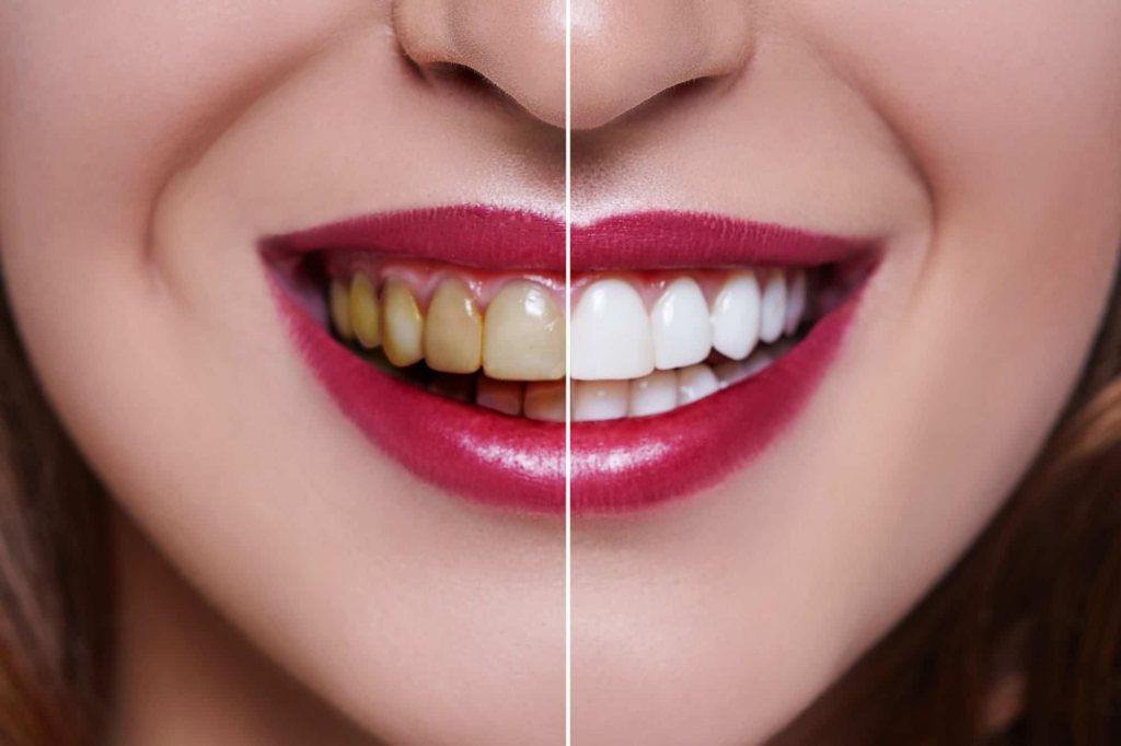 Misfarging av tennene vs. hvite tenner