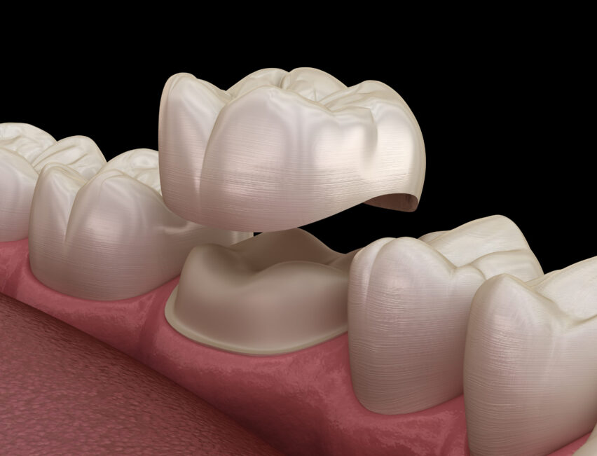 Ved bruk av en tannrkone kan tannens styrke og utseende bli gjennopprettet
