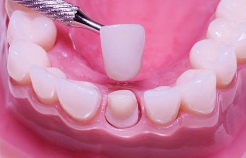 Tannlege setter på en tannkrone