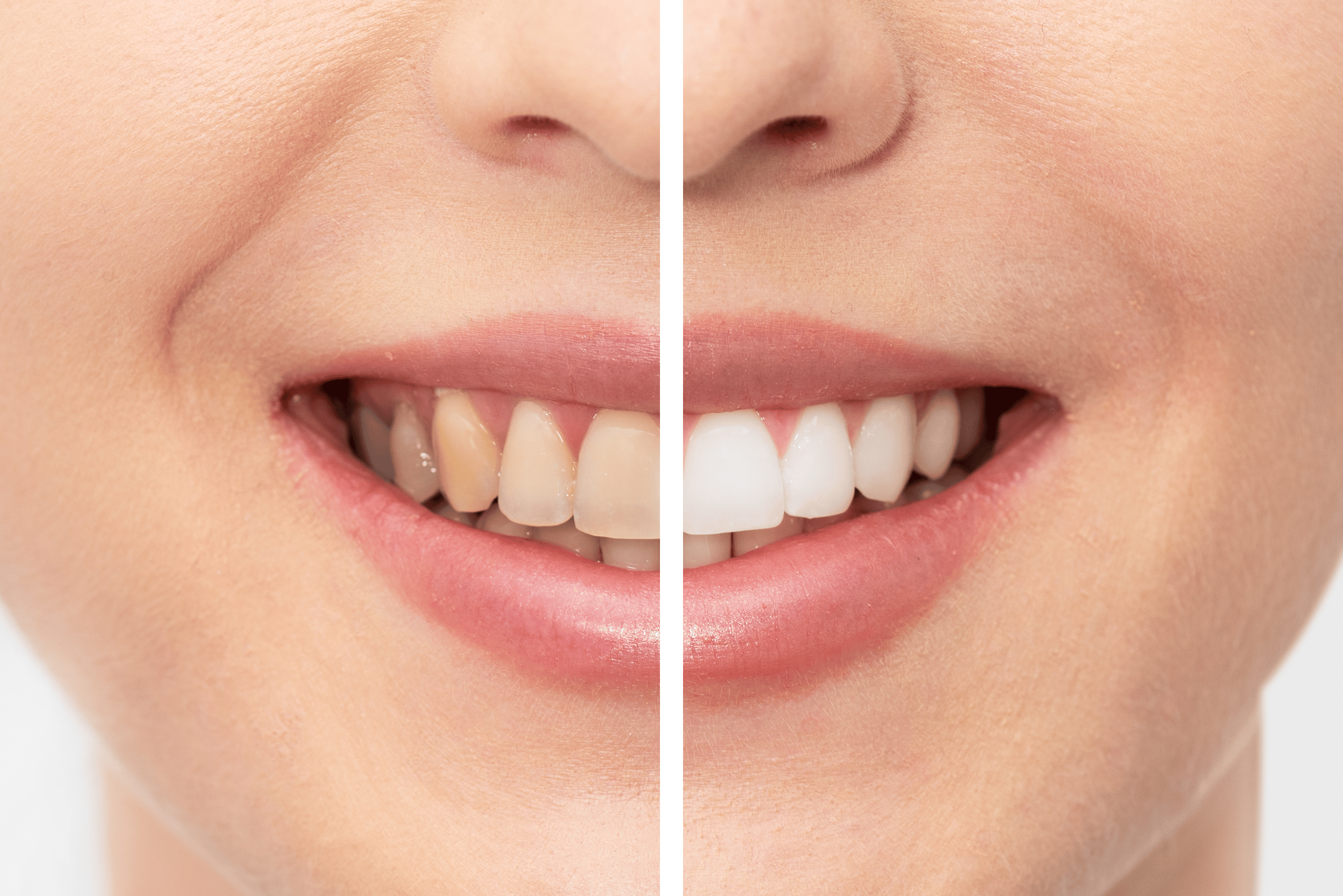 Kvinne som hadde misfargede tenner og nå har hvite tenner