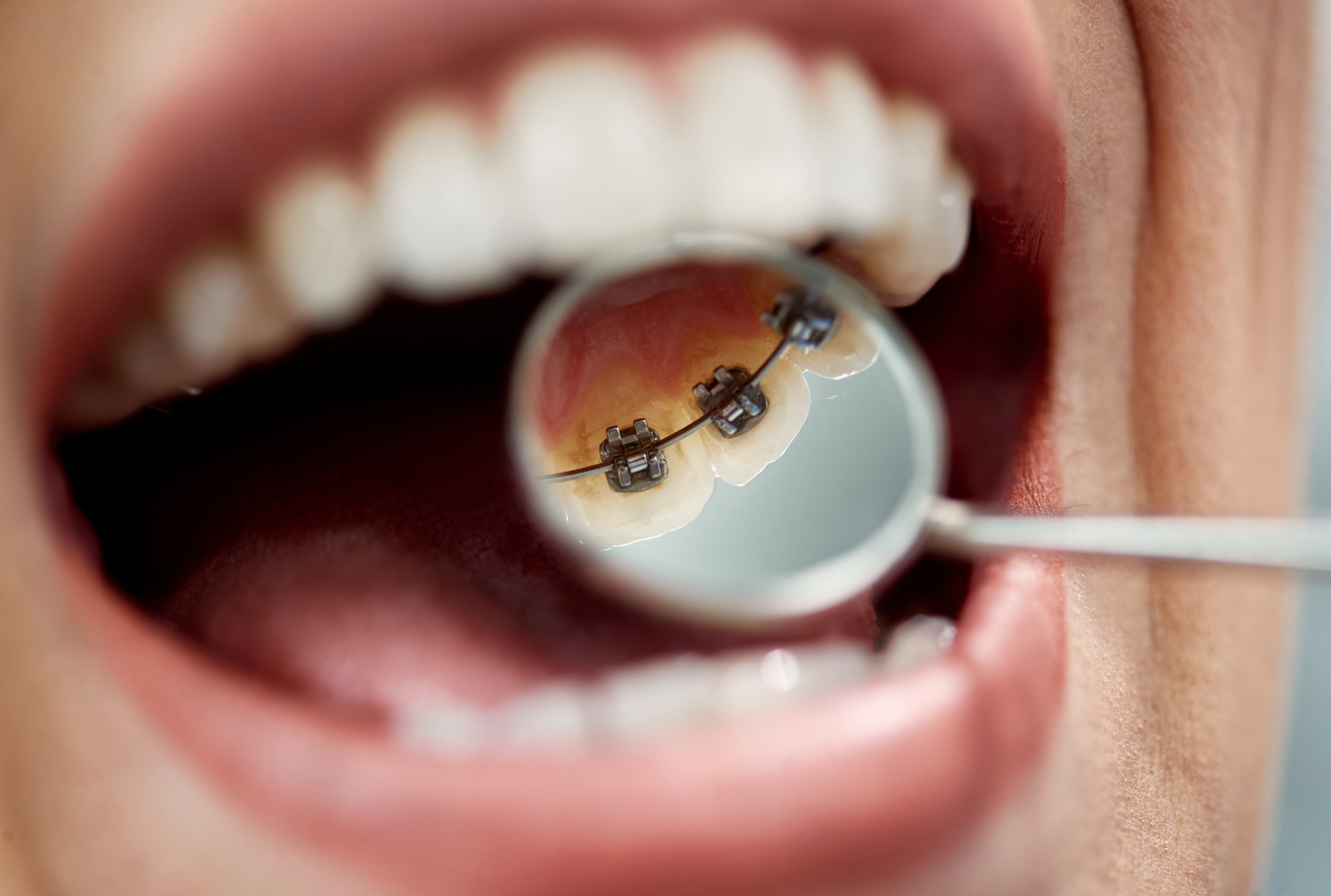 Person med tannregulering bak tennene