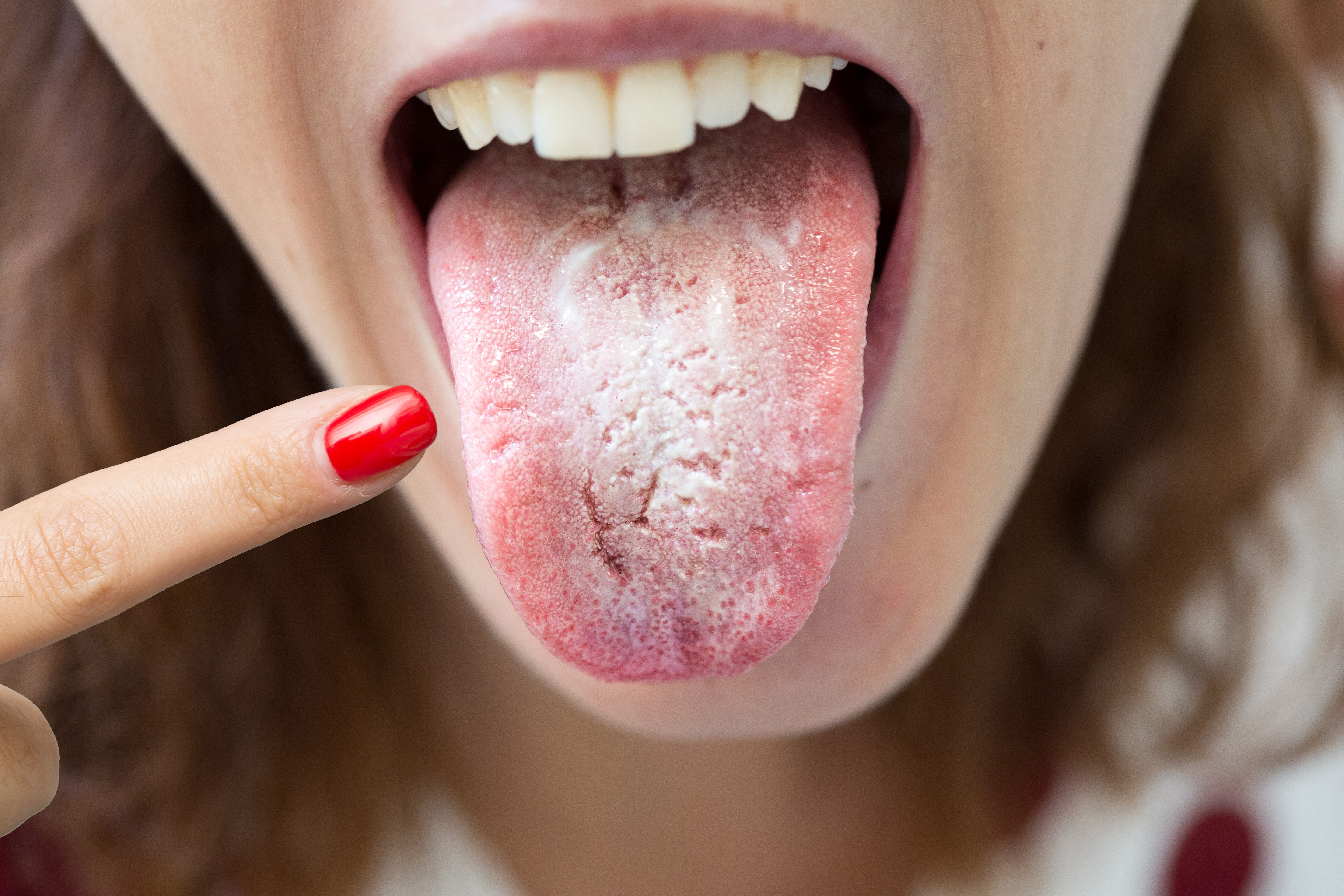 Kvinne med sopp på tungen