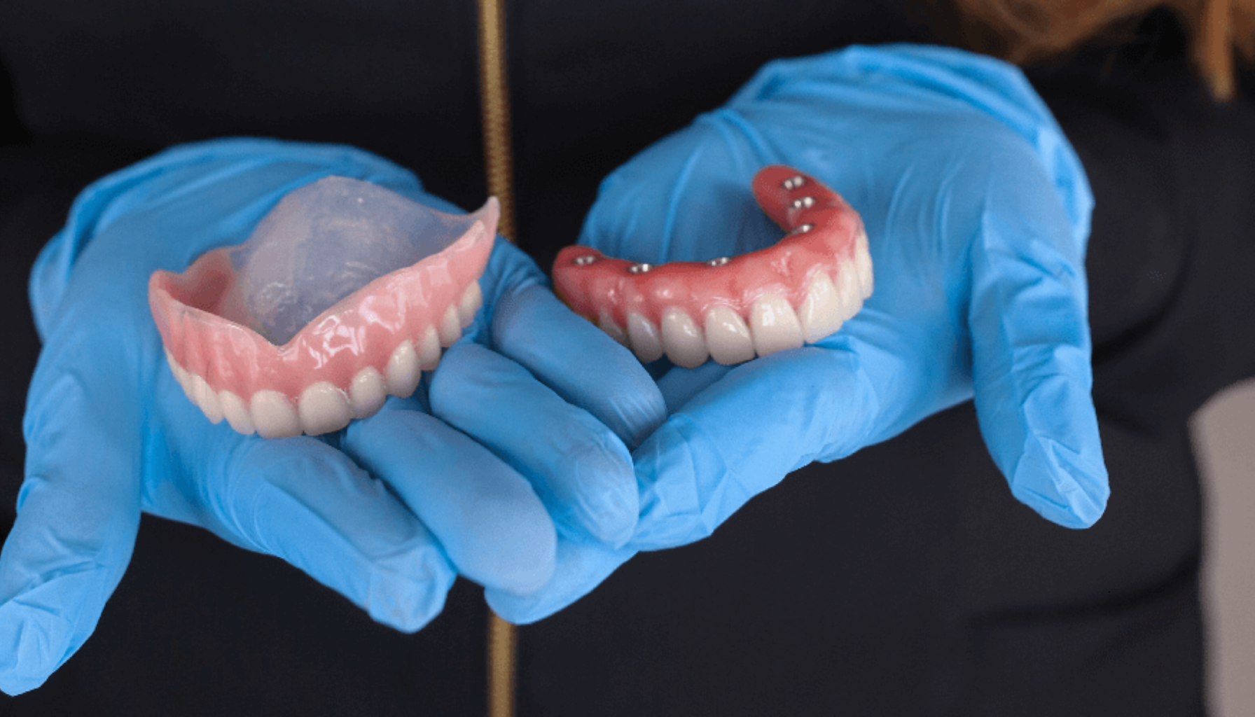 Person med blå hansker holder to tannproteser i hendene, én helprotese og én delprotese med implantatfester.