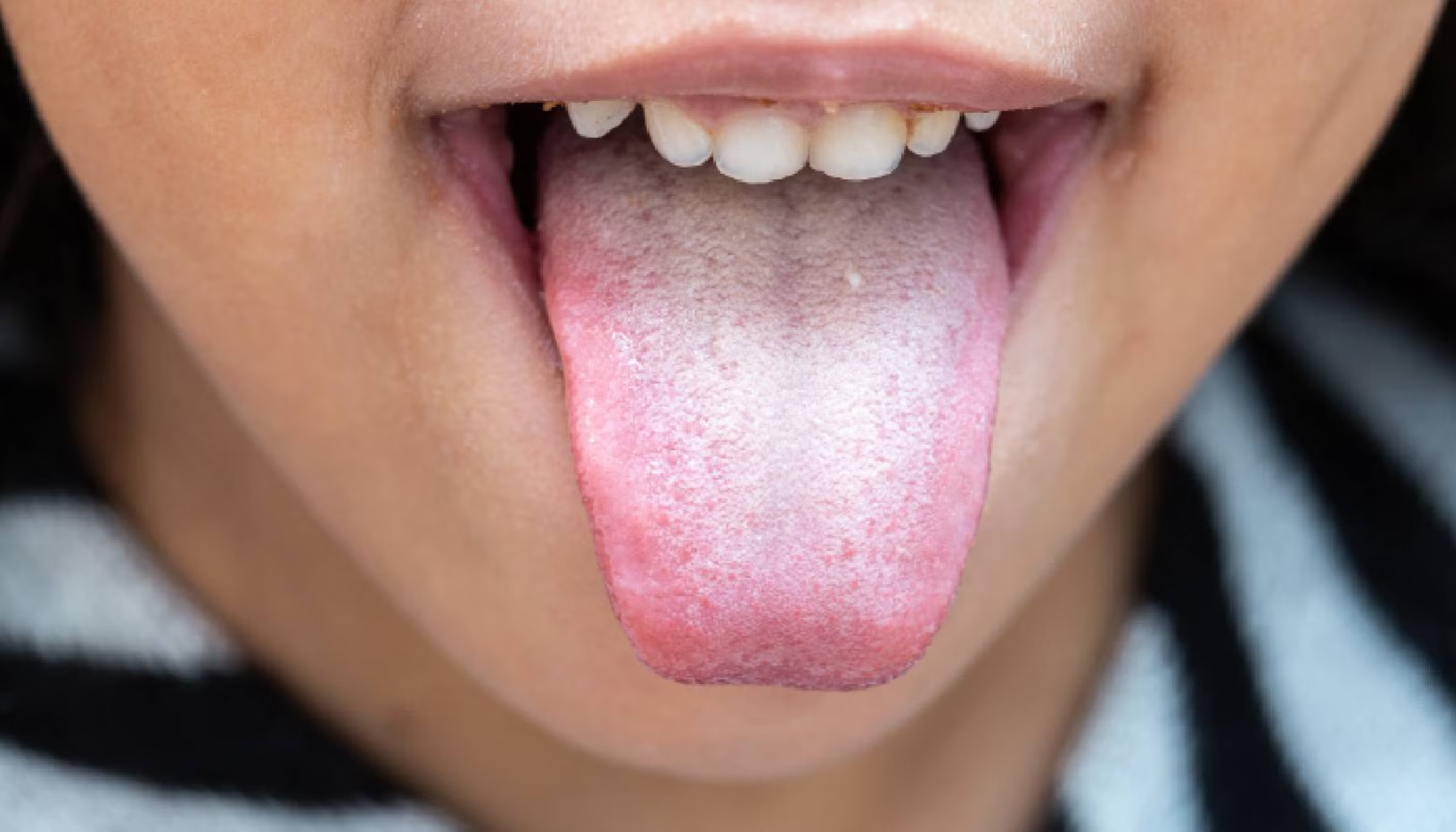 En nærbilde av en tungen som viser hvit belegg, et tegn på mulig soppinfeksjon eller dårlig hygiene.