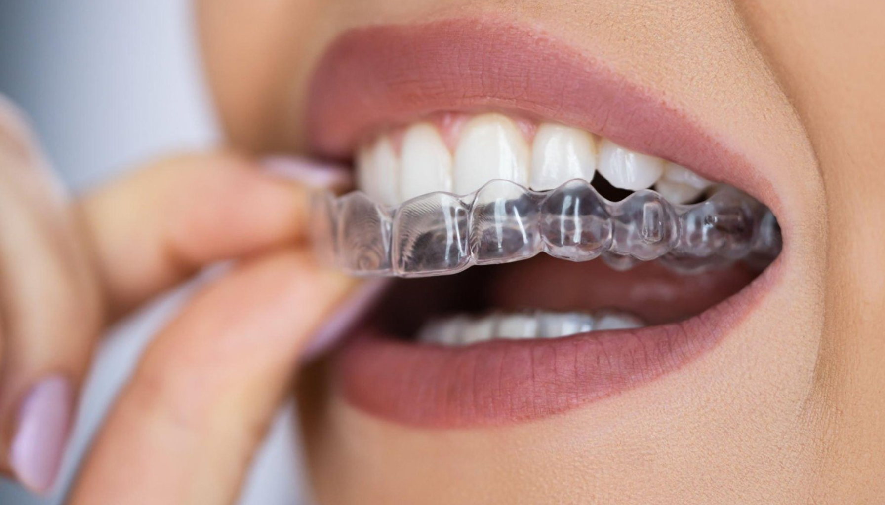 "Nærbilde av en person som setter inn en gjennomsiktig tannskinne over hvite tenner." tenner med invisalign