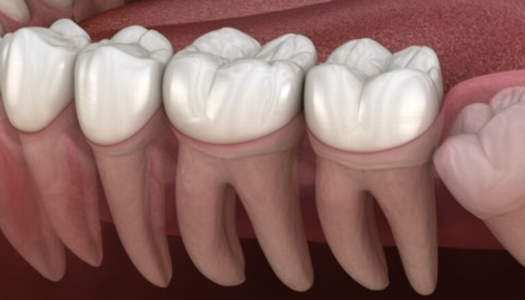 3D-illustrasjon av en visdomstann som vokser skjevt og presser mot nabotannen i underkjeven. flere årsaker fjernet molar tilfeller fjerne kirurgi ofte årsaker års oftest kommer nødvendig liten derfor grunn frembrutte tillegg tegn første kontroll gjøre fått 